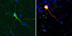Dementia in a dish:Neurons differentiated from iPS cells from a healthy individual (left) and from a patient with with a FTD-associated tau mutation (right). Green marks neurons. The red colour shows a abnormal tau protein. The yellow/orange colour results from the overlay of both markers. Blue shows cell nuclei.
