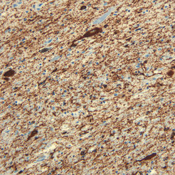Tau protein aggregation in a FTD-patient:The so called substantia nigra, a brain region that is important for planning and starting of movements, shows massive aggregations of abnormal tau proteins (brown staining).
