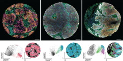 Beispiele für Patientenbiopsien, die mit einer Reihe fluoreszierender Antikörper angefärbt wurden (obere Felder). Durch die Extraktion der Fluoreszenzintensitäten zusammen mit den morphologischen Merkmalen von Zellen und Gewebe kann eine multiparametrische Beschreibung jeder Zelle im Gewebe erstellt werden (unten links; jeder Punkt im Feld steht für eine einzelne Zelle). Durch die Gruppierung dieser Zellen auf der Grundlage ihrer Ähnlichkeit werden patientenspezifische Fingerabdrücke erstellt (unten rechts).